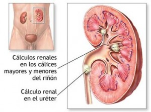 nefrolitotricia_percutanea_calculos_renales