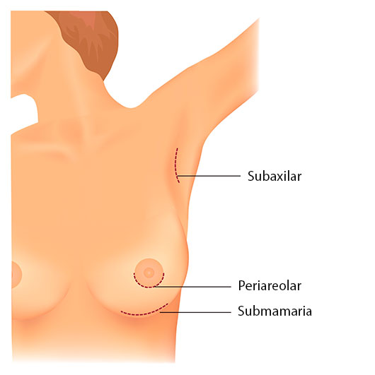 incisiones-mamoplastia